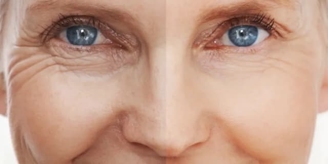 One Fibroblast Skin-Tightening and Wrinkle-Reducing Treatment on Medium Area