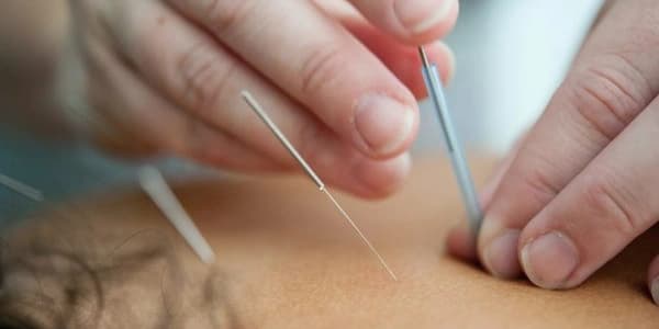 Comprehensive Acupuncture Evaluation and Initial Treatment