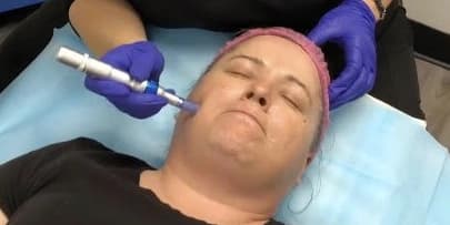 Micro Needling Full Face Treatment