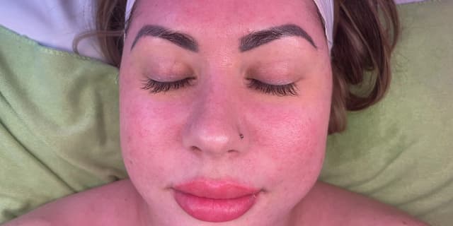 Microneedling with Skin Stylus Pen