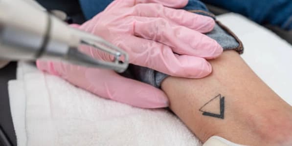 Two Laser Tattoo Removal Sessions on a Large Area