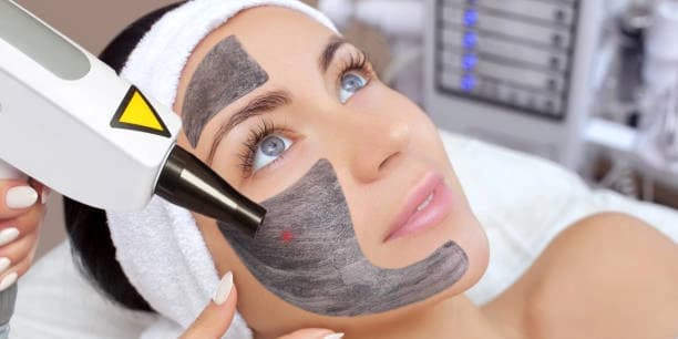 Carbon Laser Facial