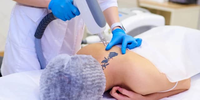 Four Laser Tattoo Removal Sessions on a Small Area