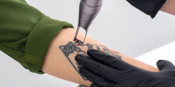 Two Laser Tattoo Removal Sessions on a Medium Area