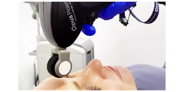 Opus RF Plasma Full Face Skin Tightening - Reduce Fine Lines, Wrinkles and Pore Size While Evening Out Skin Tone!