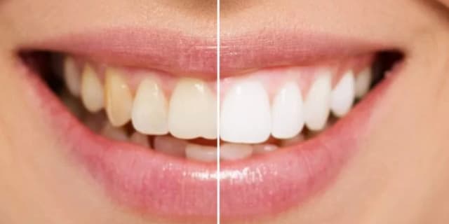 One Hour Laser Teeth Whitening Session