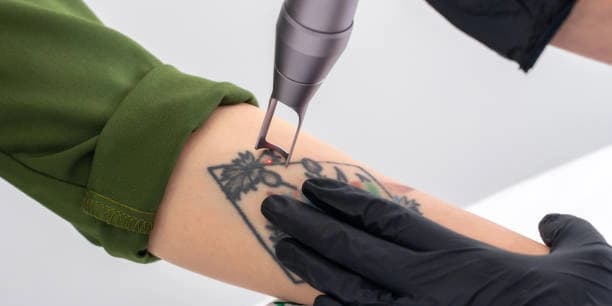 Three Laser Tattoo Removal Sessions for up to 15 square inches