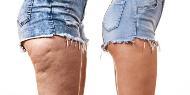 Six Ultrasonic Fat- and Cellulite-Reduction Treatments