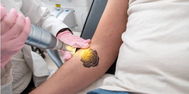 Three Laser Tattoo Removal Sessions for up to 12 square inches