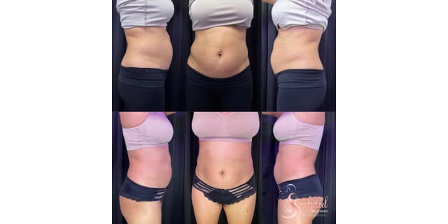 Body Contouring for One Area