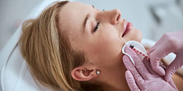 Mesh Threads - Two Threads (fill in nasolabial folds)