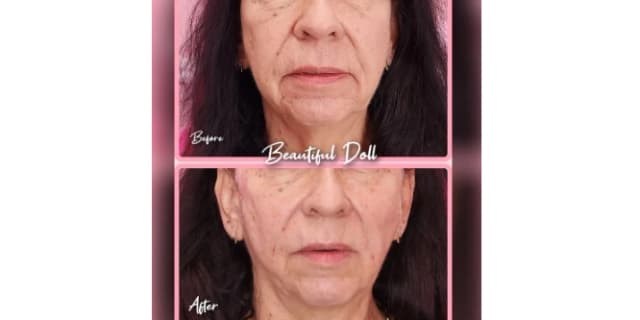 Barbed Lifting PDO Threads - Four Barbed Lifting Threads (Lunchtime Facelift)