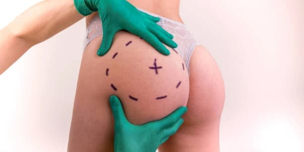 Three Non-Invasive Butt Lift Sessions