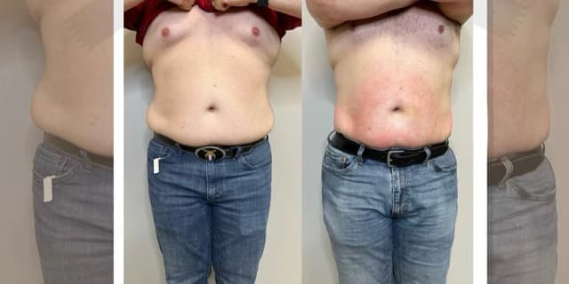 Four Laser-Lipo Body Sculpt Sessions