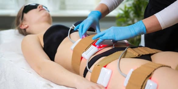 Nine Laser-Lipo Body Sculpt Sessions