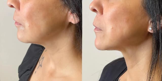 Three Radio-Frequency Skin-Tightening Treatments for Lower Face & Neck