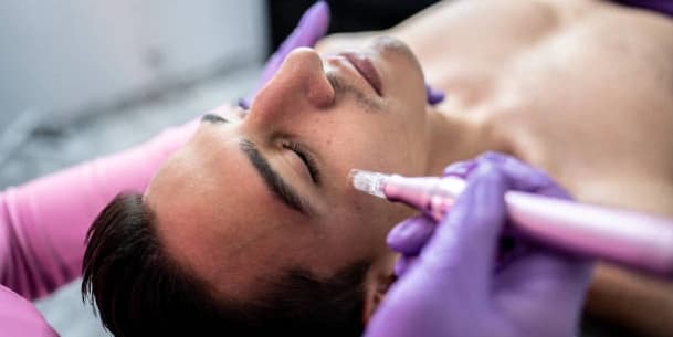 Two Micro Needling Treatments