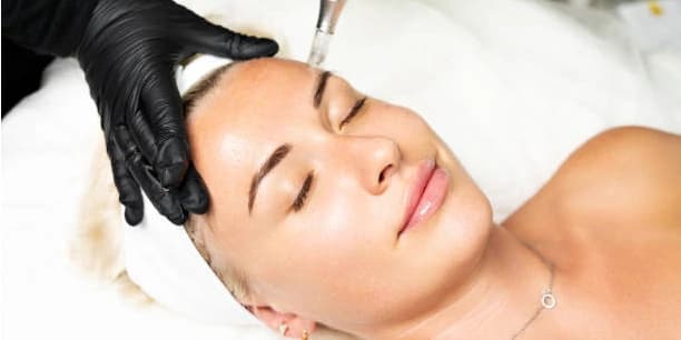 Microneedling Treatment