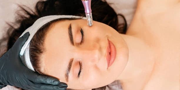 Microneedling w/ Hyaluronic Acid
