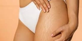 One Laser Skin Resurfacing Session for Stretch Marks (Large Area)