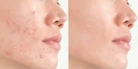 One Acne Scar Treatment