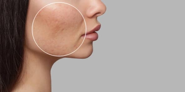 Three Acne Scar Treatments (Treated Area Only)