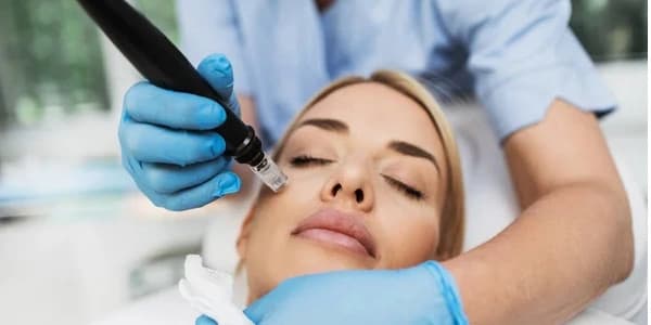 Three Microneedling Sessions - Package Deal