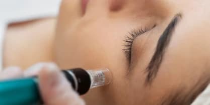 One Microneedling Session