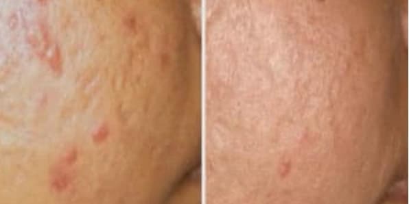 Acne Bootcamp Consultation & Facial