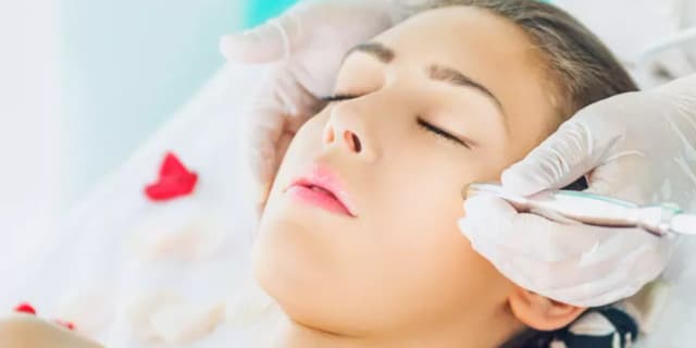 One Radiofrequency Microneedling Treatment of Face