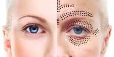 One Fibroblast Eyelift Treatment
