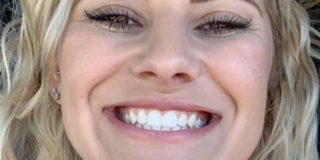 One Teeth Whitening Session