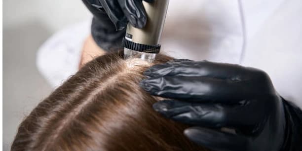 90-Minute Stem Cell Hair Microneedling for Non-Surgical Hair Restoration