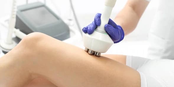 Two - Stretch Marks on Body with Laser Plasma