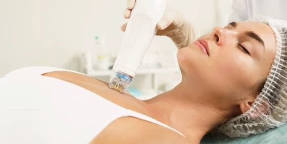 Stretch Marks on Body with Laser Plasma