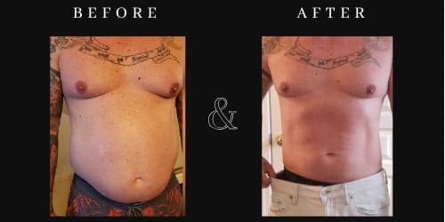 2 - (Hifem + RF) - Muscle Building + Fat Reduction Treatment