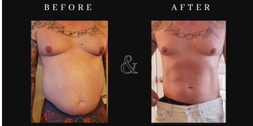 (Hifem + RF) - Muscle Building + Fat Reduction Treatment