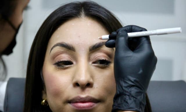 40 Units of Botox at Peach Skin & Laser