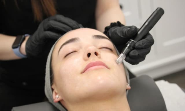 Two Microneedling Sessions