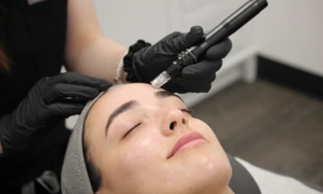 One Microneedling Session