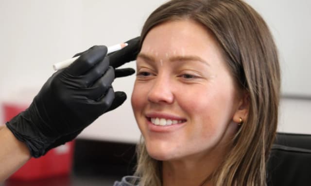 40 Units of Xeomin at Peach Skin and Laser