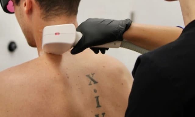 Three Laser Hair-Removal Sessions on One Medium Area (Touchup)