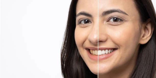 One Teeth Whitening Treatment