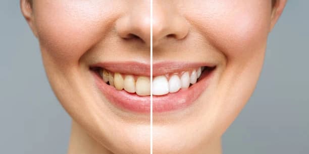 Three Teeth Whitening Treatments