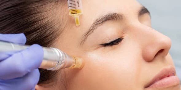 Microneedling Scar Removal