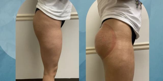 Vacuum BBL Butt Lift Therapy (Per Area)