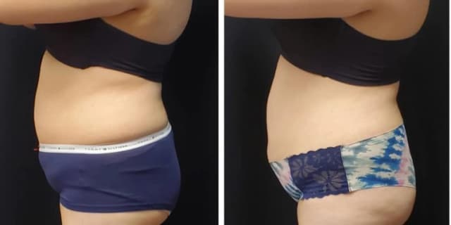 Lipo Wrap to Go with Osmotic Wrap