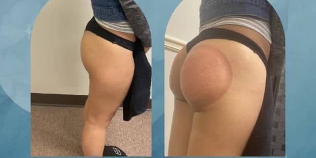Vacuum BBL Butt Lift Therapy for Both Areas