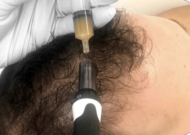 PRP Micro-needling for Hair Revision