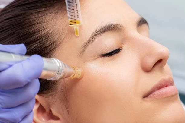 PRP Micro-needling for Face
